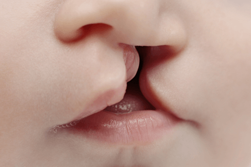 Essential Information on Orofacial Clefts: What You Should Know
