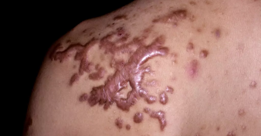 Tackling Keloids: Effective Ways to Treat and Manage Them