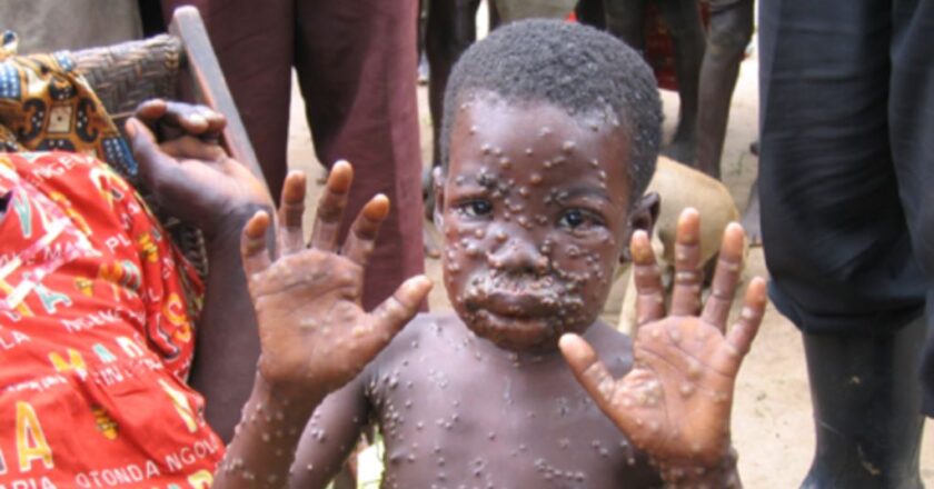 Monkey pox Spreads To Rivers And Akwa Ibom