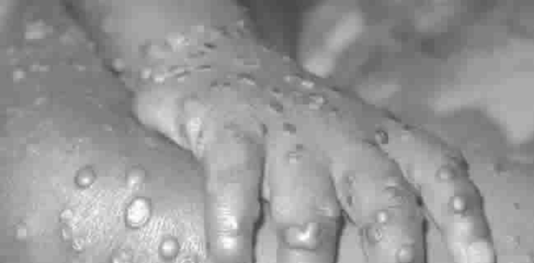 What Nigerians Must Avoid Eating To Prevent Monkey Pox Virus – FG