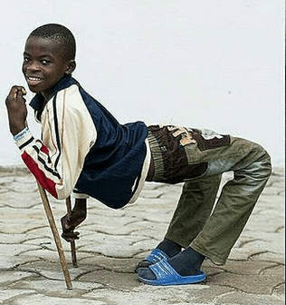 12-Year-Old Boy Full Of Joy After Undergoing Successful Surgery To Correct His Backward Facing Legs