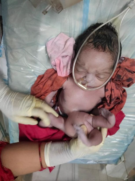Baby born with four arms and four legs hailed as 