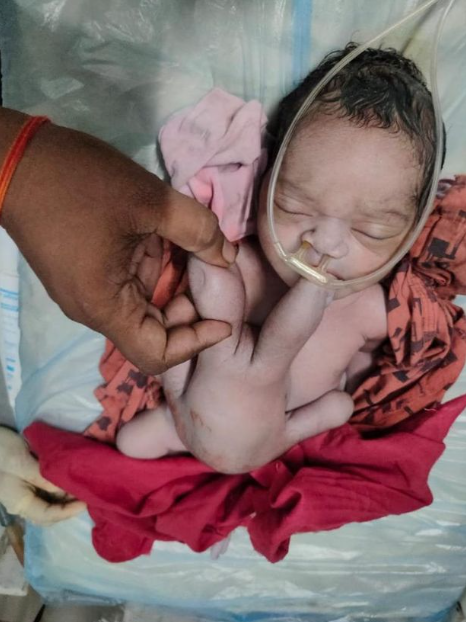 Baby born with four arms and four legs hailed as 