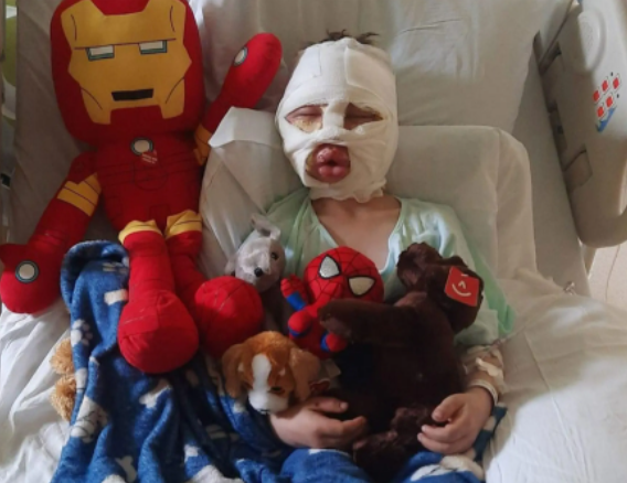 6-year-old boy severely burned after bully threw flaming tennis ball at him