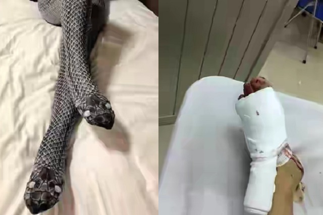 Man Breaks His Wife’s Legs Thinking It Was Snake Heads