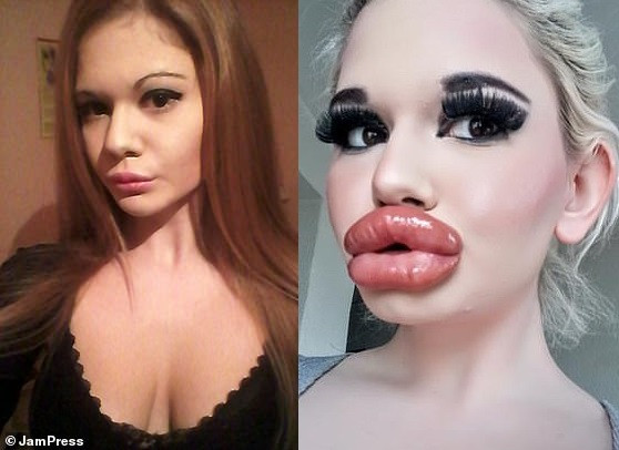 “`html
'Real-Life Barbie' with the 'biggest lips in the world' shows off huge new pout after 20th filler Injection (photos)
