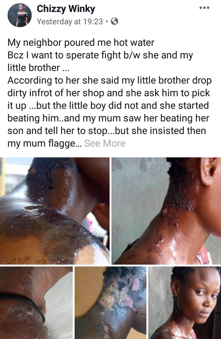 Girl suffers severe burns after her neighbour poured boiling water on her
