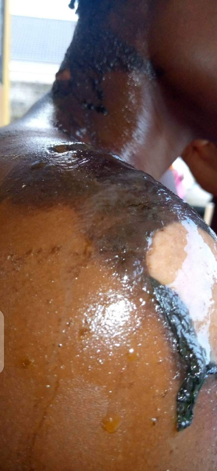 Girl suffers severe burns after her neighbour poured boiling water on her