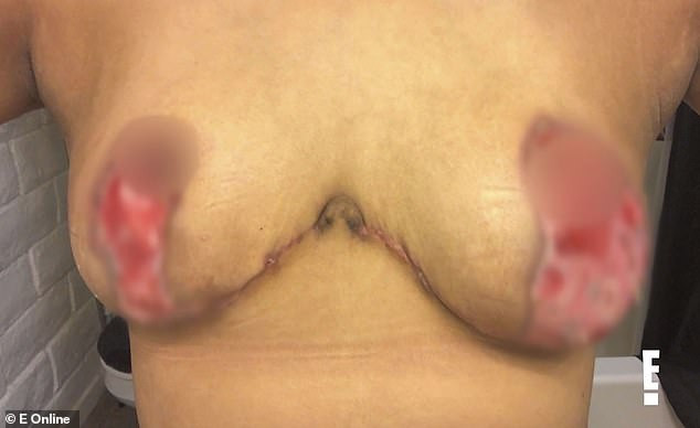 Woman is left with rotting breasts that smelled like decayed flesh after a botched surgery (graphic photos)