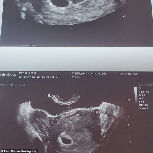 Amanda Bynes is pregnant with her first child; shares ultrasound photo