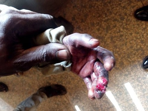 Man arrested for burning son, 5, on hot pan for stealing fish (graphic photo)