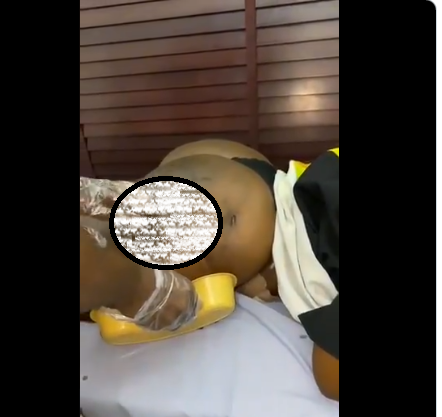 Disturbing video shows woman screaming out in pain as fat leaks out of her butt following a botched plastic surgery 