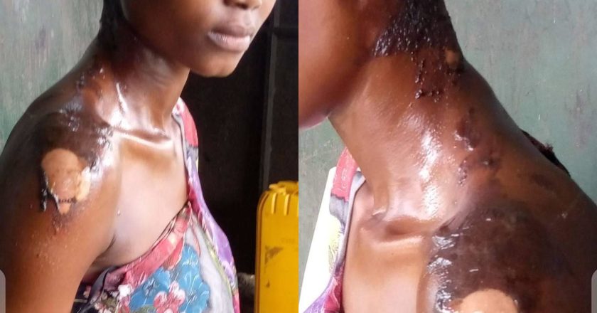 Shocking Incident: Girl Endures Severe Burns in an Attack by Her Neighbor