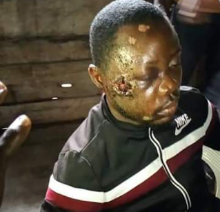 Man vomits bullet lodged in his head months after he was shot by unknown gunmen in Bayelsa (photos)