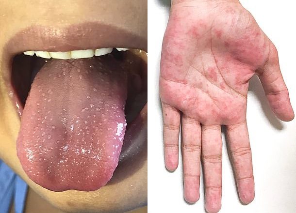 NHS issues urgent alert as children are being admitted to intensive care with a new Coronavirus-related 'inflammatory syndrome' (photo)