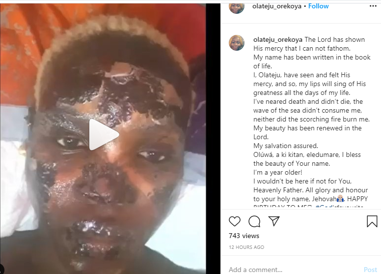 Nigerian lady celebrates her birthday months after surviving a gas explosion