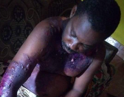 Nigerian Man Slapped His Wife, She Retaliated by Pouring Hot Water on Him While He Was Asleep (Photos)