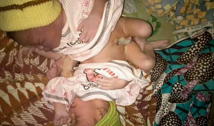 Conjoined Twins in Kaduna Remain at Home Two Weeks After Birth Due to Lack of Funds