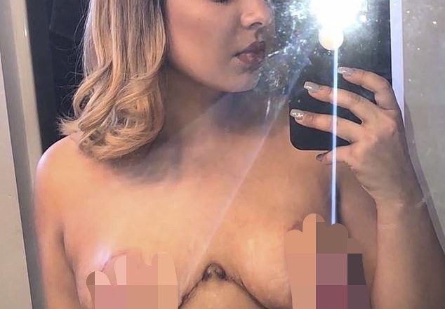 The shocking aftermath of a breast reduction surgery gone wrong