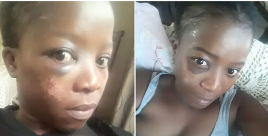 <article>
  “He dragged me while I was screaming and bleeding” – South African lady accuses a married man of beating and raping, shares photos of her battered face