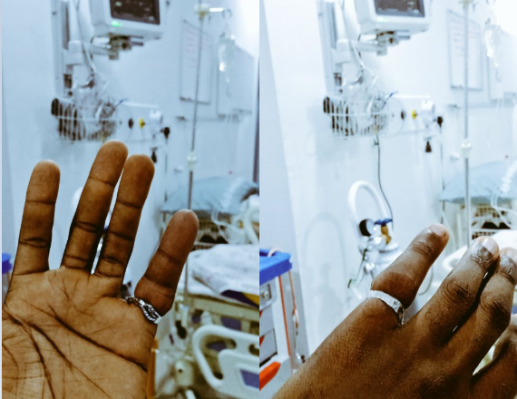How a Man Ended up in the Hospital After His Engagement Ring Got Stuck on His Finger