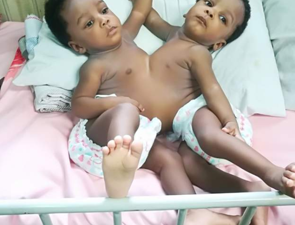 Nigerian doctors successfully separate conjoined twins (see photos)