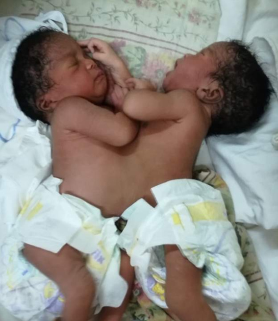Nigerian doctors separate conjoined twins (photos)