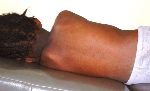 Tragic Outcomes of Measles in Adamawa: 19 Children Lost