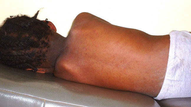 Tragic Outcomes of Measles in Adamawa: 19 Children Lost